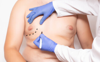 Saiba o que é ginecomastia: condição que afeta a mama dos homens