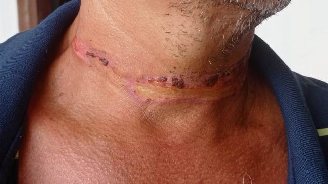 Motociclista é atingido no pescoço por fio de telefonia solto em via pública e socorrido para a Upa (Foto: Ed Santos/Acorda Cidade)