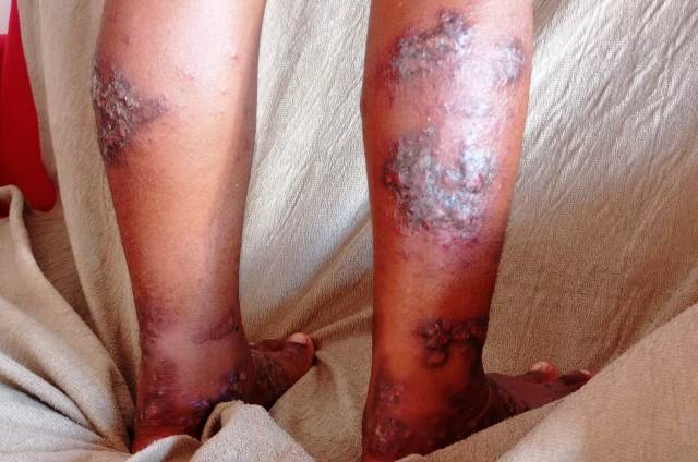 Garoto diagnosticado com dermatite atópica grave e sofre com as feridas e bolhas espalhadas pelo corpo. (Foto: Ed Santos/ Acorda Cidade)