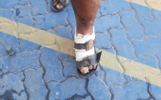 Morador do Jussara com pé diabético diz que faltam materiais para curativo em unidades de saúde