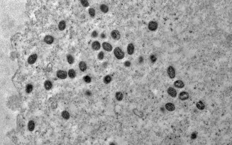 Pesquisa indica risco de monkeypox agravar infeccão por HIV