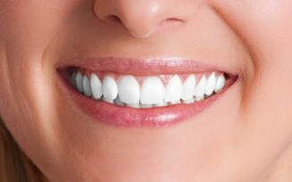 Implantes dentários: 5 fatos que você precisa saber antes de realizar o procedimento