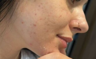 Ana Castela faz desabafo que sofre muito com acne "Eu uso muita maquiagem e como mal"