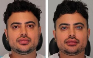 Homem viraliza após fazer procedimento para alterar cor dos olhos de forma permanente