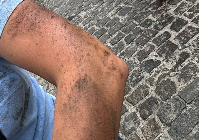 Médica sofre acidente de moto no bairro São João após derrapar em óleo descartado na rua3