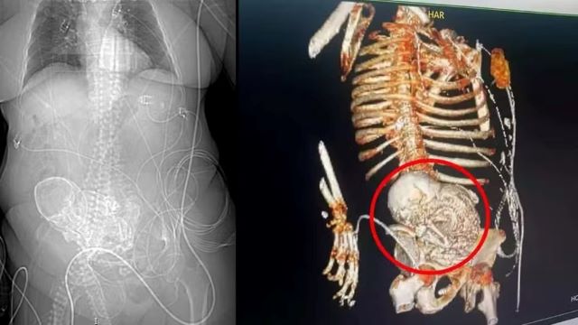 Tomografia mostra como 'bebê de pedra' estava em útero de idosa em Ponta Porã (MS