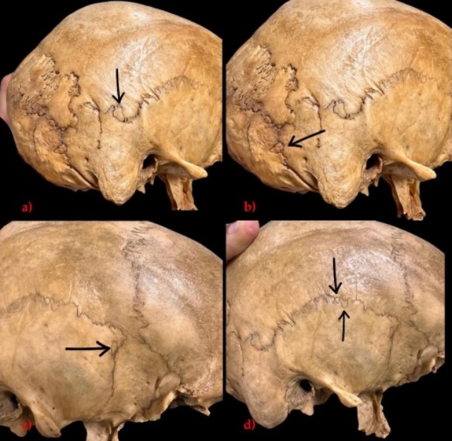 Pesquisa da UNEF revela rara presença de 40 ossos Wormianos em um único crânio